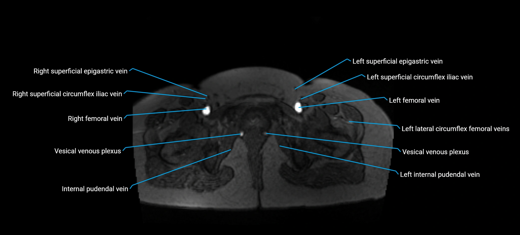 MRV abdomen pelvis & lower limb axial cross sectional anatomy labelled MRI image 190 (1).webp